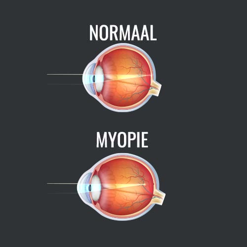 Myopie en noormaal oog